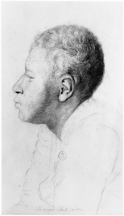 Cretino, profilo, illustrazione da un trattato inedito di Jean Etienne Dominique Esquirol (1772-1840) sui pazzi dell